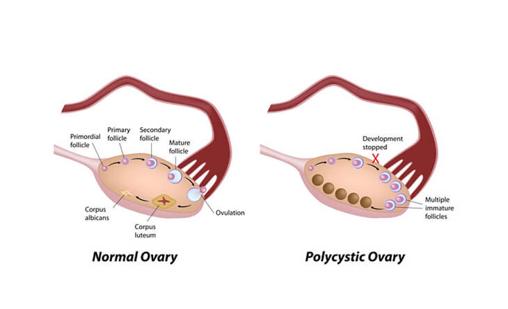PCOS treatment
