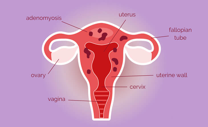 Endometriosis Treatment