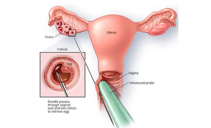 IVF Treatment