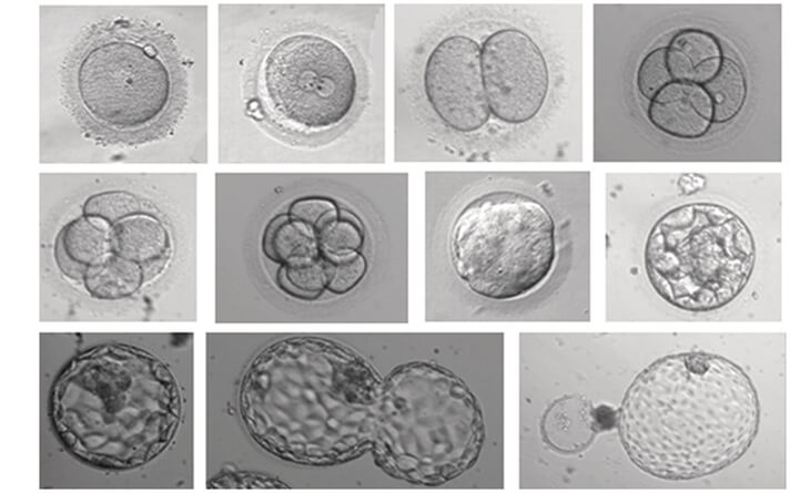 IVF Treatment