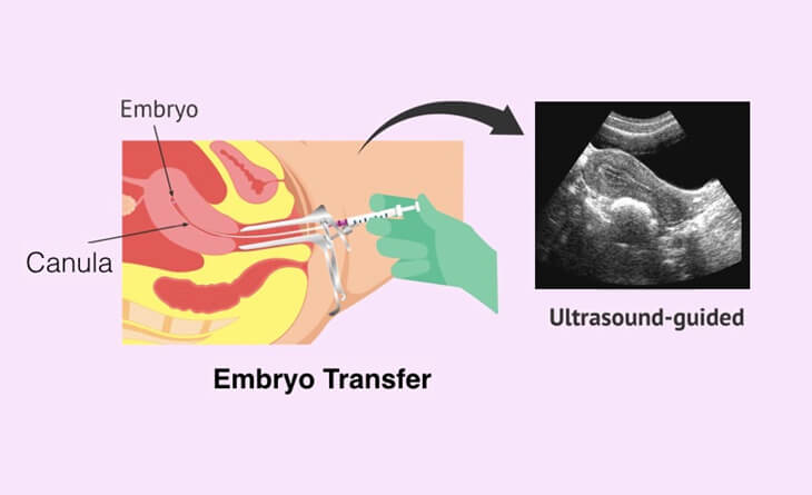 IVF Treatment