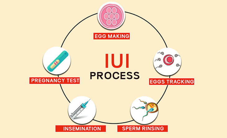 iui treatment cost in delhi