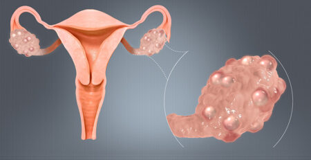 PCOS Treatment in Delhi