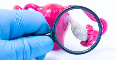 PCOS treatment