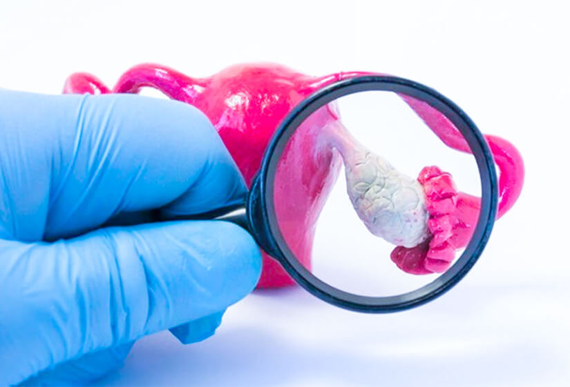 PCOS treatment