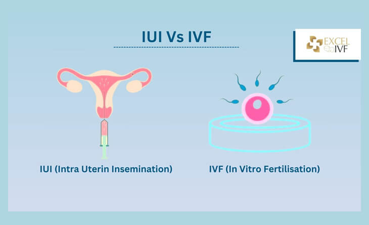 IUI Treatment