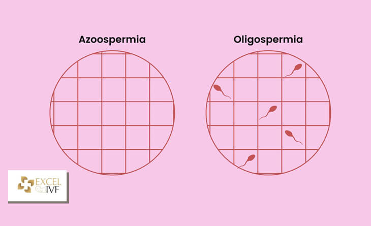 Azoospermia treatment