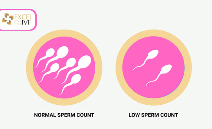 Oligospermia treatment