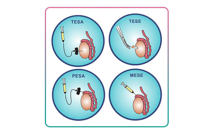 male infertility treatment