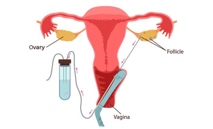 IVF treatment