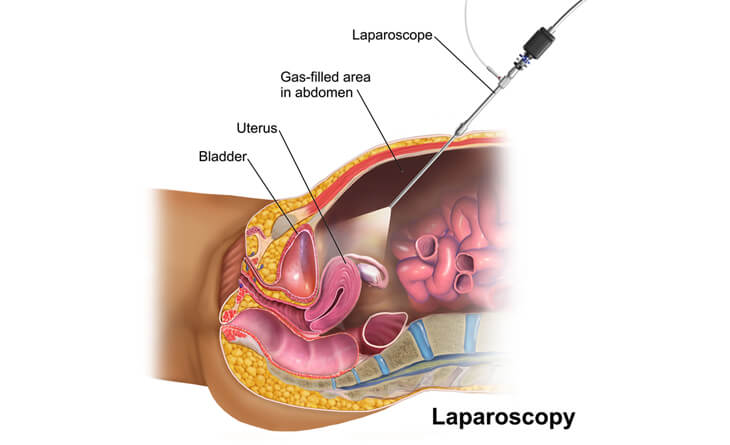 Infertility in women