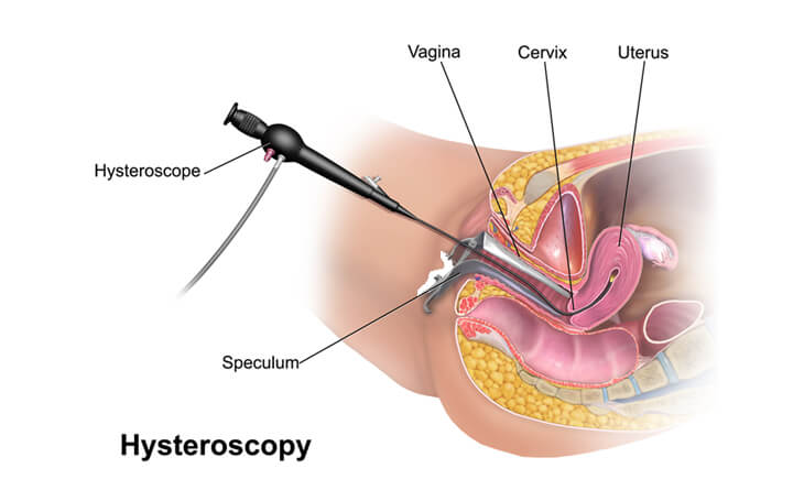 Infertility in women