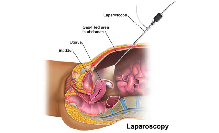 endometriosis treatment