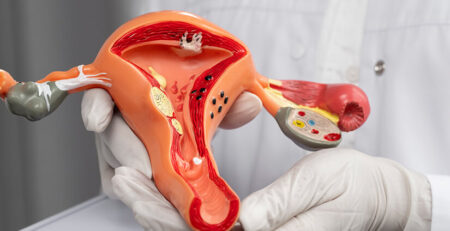 Endometriosis treatment