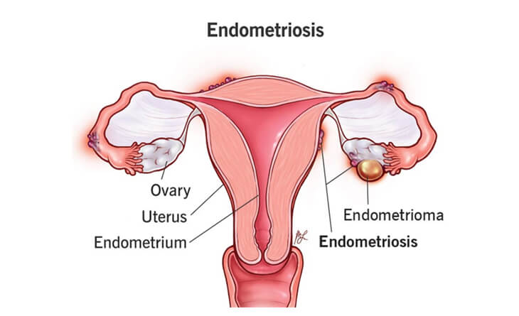endometriosis treatment