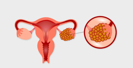 Fibroids in pregnancy