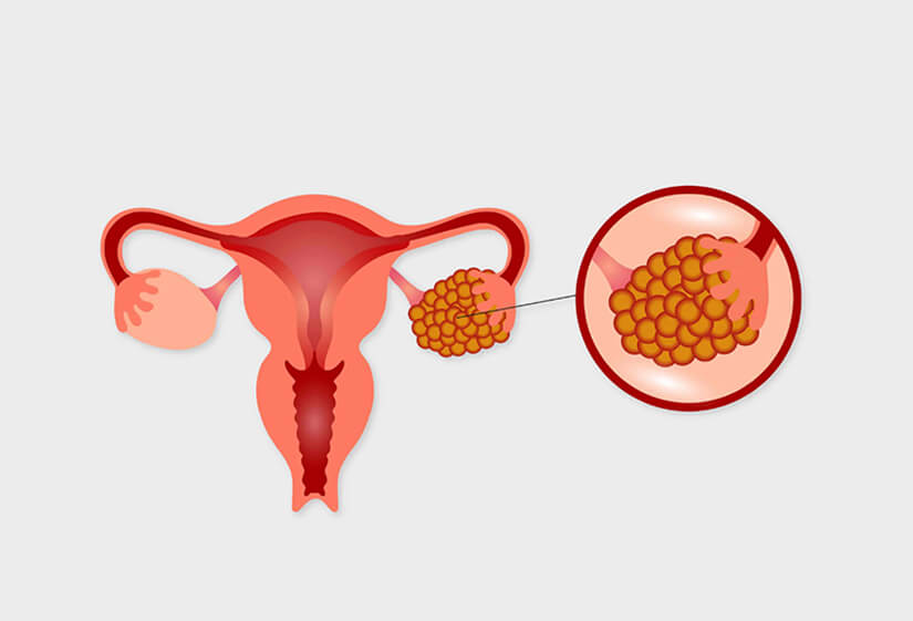 Fibroids in pregnancy