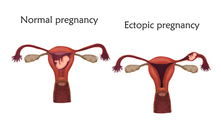 IVF Treatment