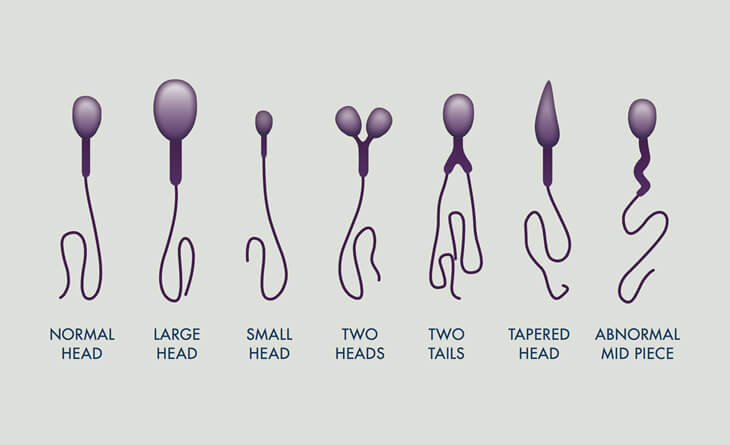 IUI Treatment