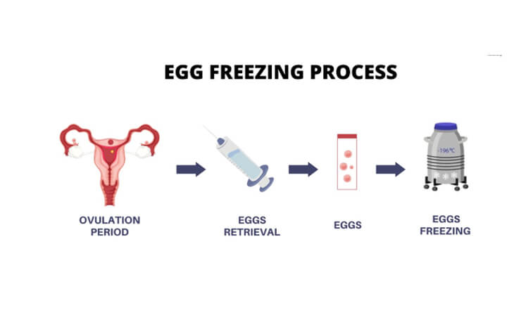 egg freezing