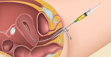 Frozen embryo transfer success rate