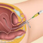 Frozen embryo transfer success rate