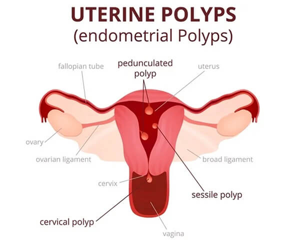 Hysteroscopy for Uterine Polyps and Fibroids- Dr Rhythm Gupta - Excel IVF -02