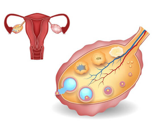 Ovulation Induction Medicines- Dr Rhythm Gupta - Excel IVF -01